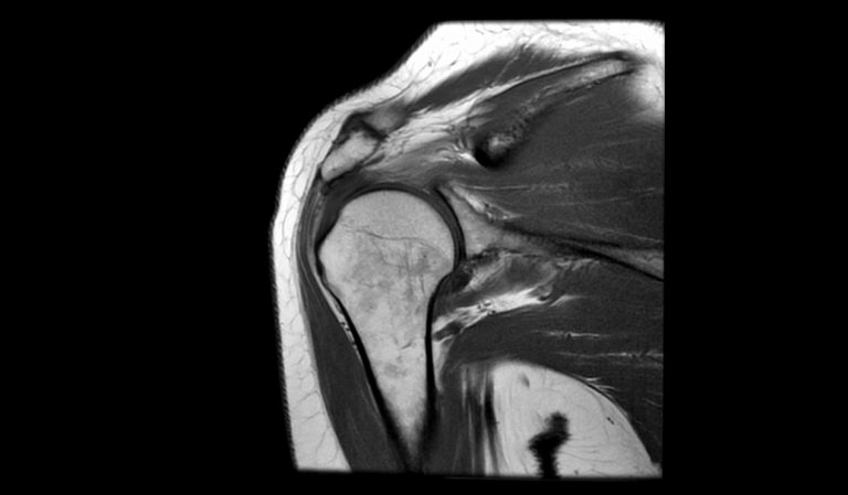 Mr Right Shoulder Case Study Greater Waterbury Imaging Center