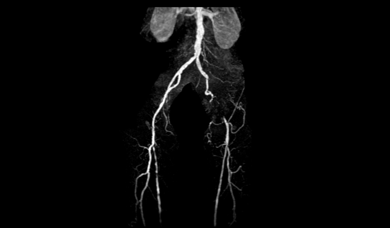 Magnetic Resonance Angiography Gwic Magnetic Resonance Angiography Gwic