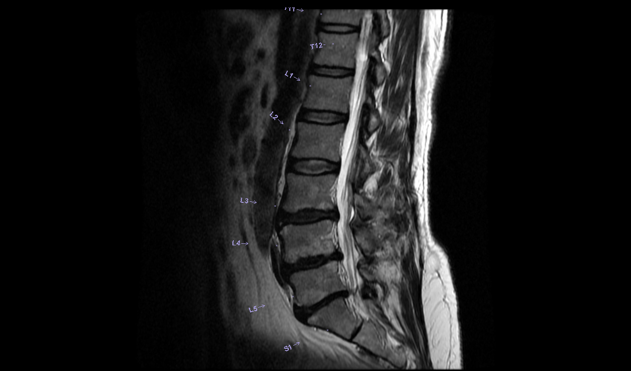 Lumbar Spine: Lumbar Spine Open Mri