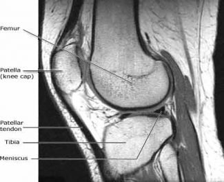 MRI lower extremity Knee Scan