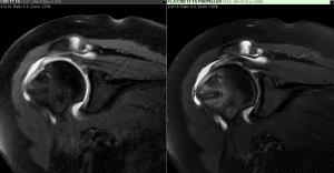 MRI Shoulder Scan