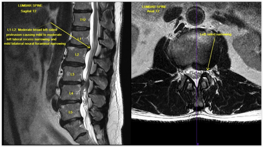 MRI Lumbar Spine Case Study Lumbar Radiculitis | GWIC