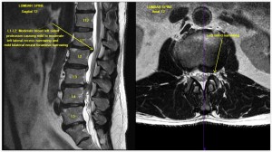 MRI lumbar spine case study