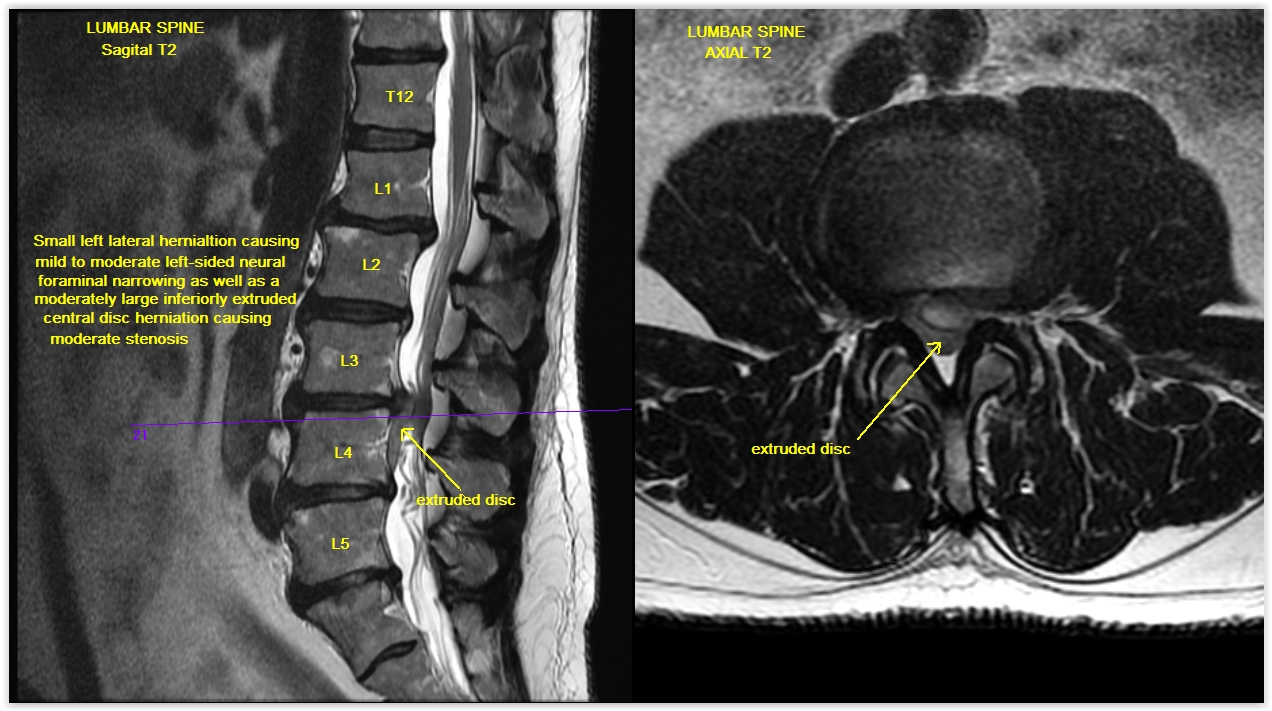 abnormal findings in urine icd 10