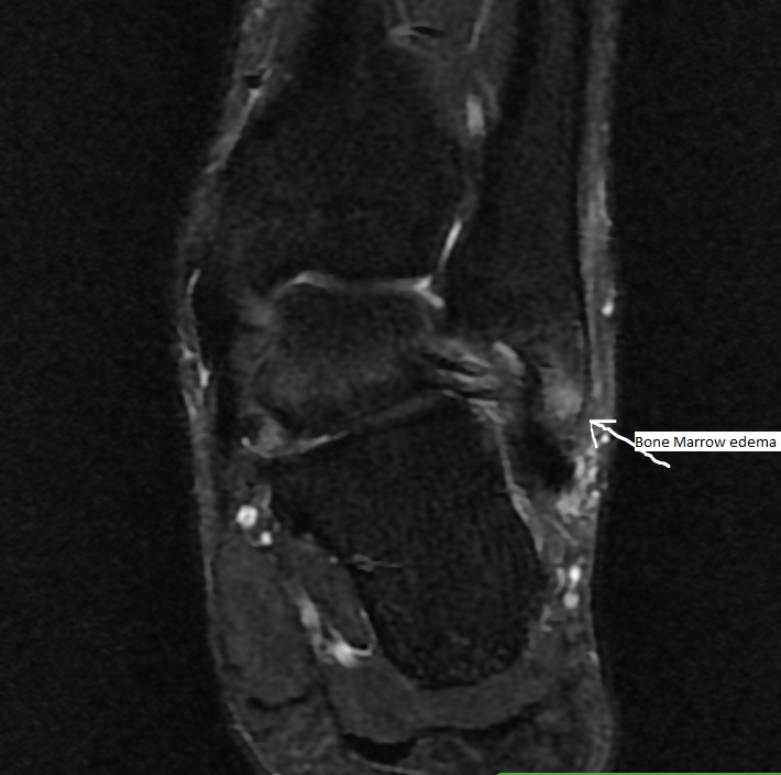 MRI Scan Left Ankle