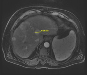 MRI Abdominal Case Study