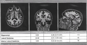 Neuroquant Age-related Atrophy Report