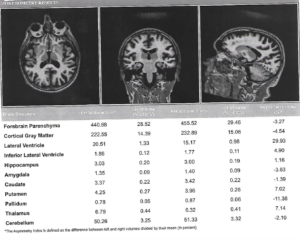 Neuroquant Dementia Case Study