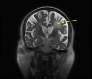 MRI Stroke Case Study