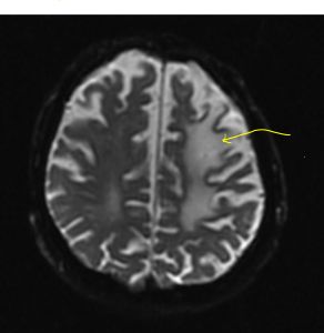 MRI Stroke Case Study