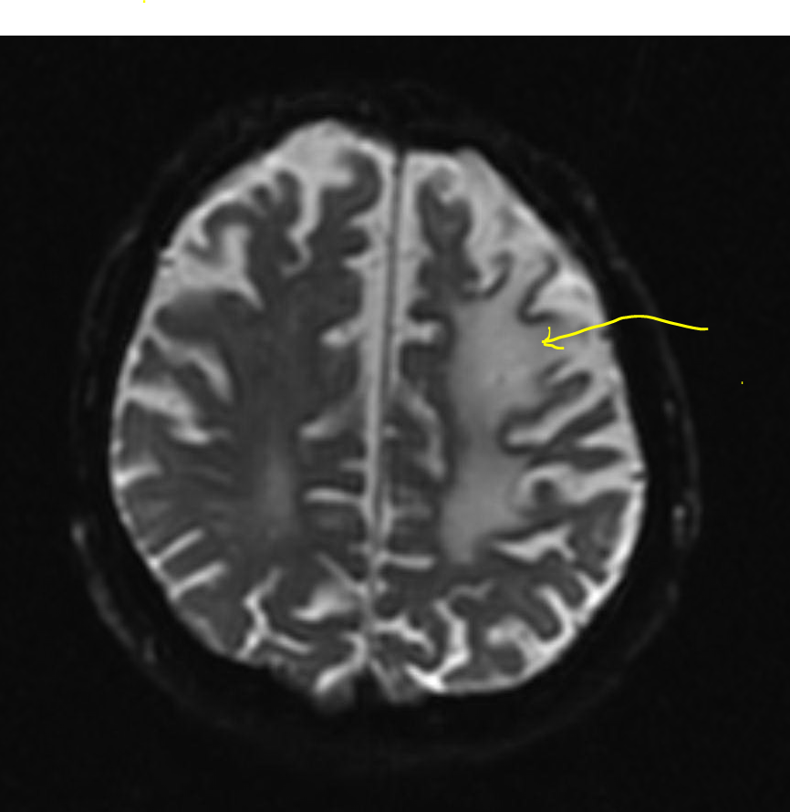 stroke mri case study