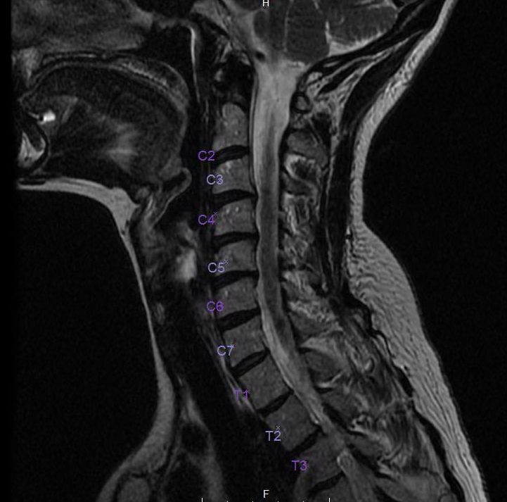 female abnormal cervical spine x ray