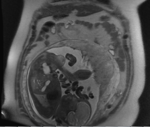 MRI Safety During Pregnancy