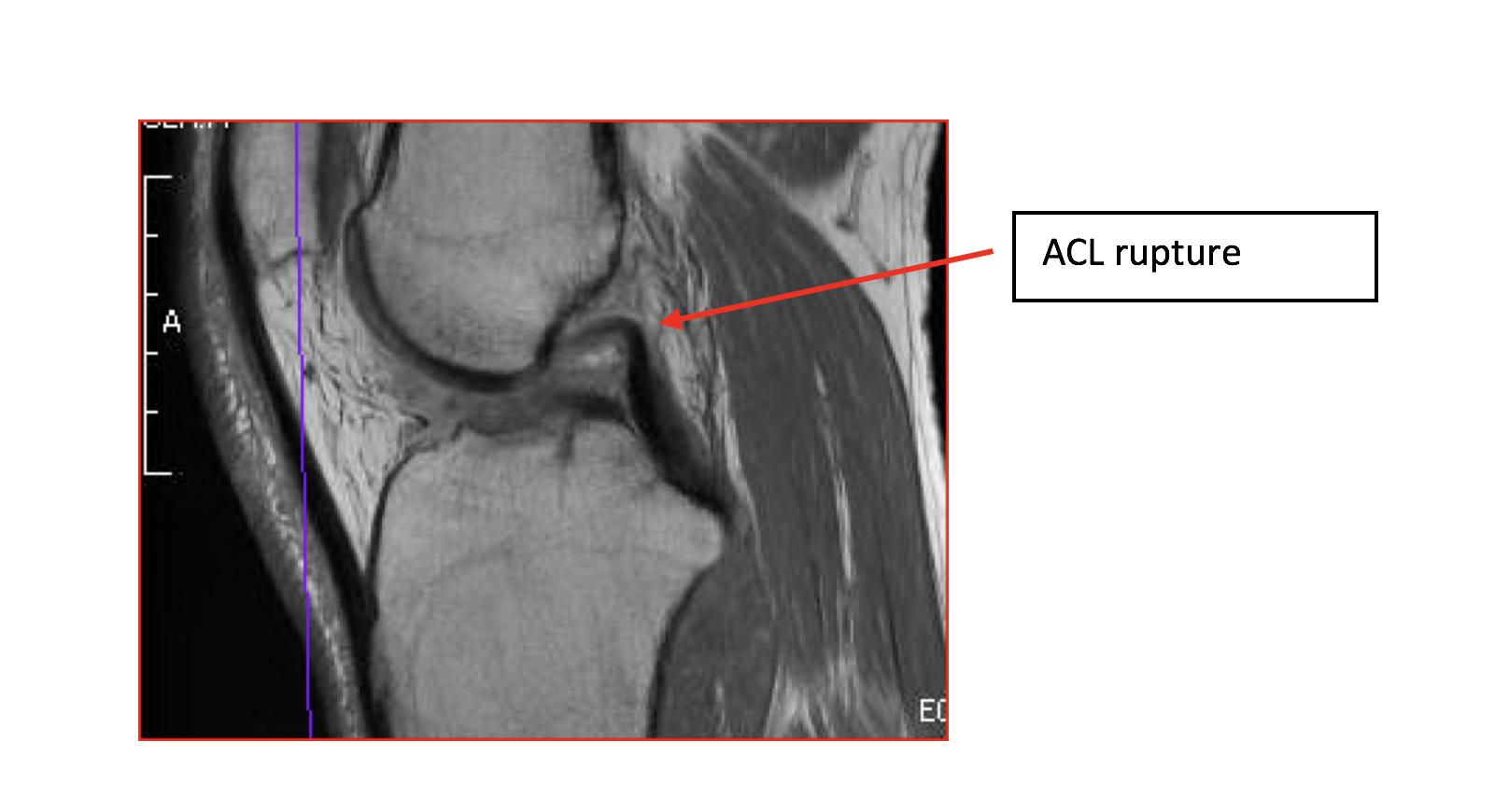 ACL injury MRI.