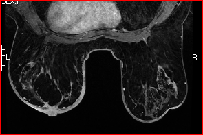 MRI Bilateral Breasts with and without IV Contrast