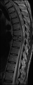 mri thoracic spine case study