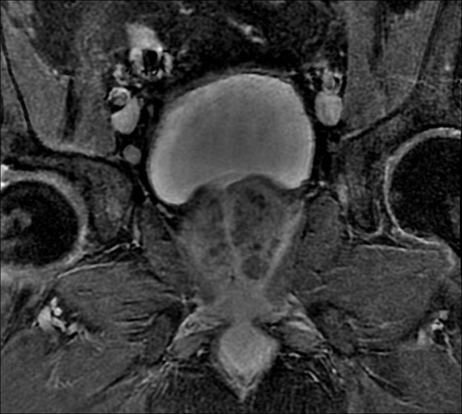 MRI Pelvis Prostate Exam Case Study