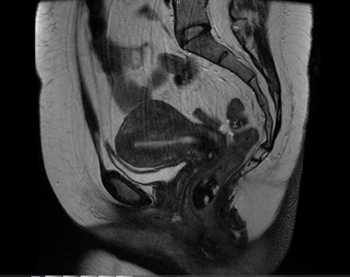 MR PELVIS WITH AND WITHOUT IV CONTRAST