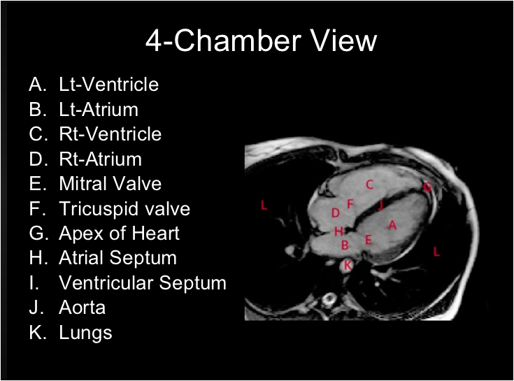Cardiac MRI Video