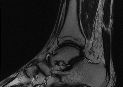 MRI RIGHT ANKLE WITH AND WITHOUT CONTRAST