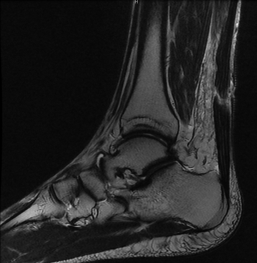 MRI RIGHT ANKLE WITH AND WITHOUT CONTRAST