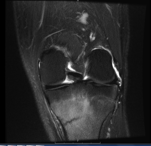 MR LEFT KNEE - Greater Waterbury Imaging Center