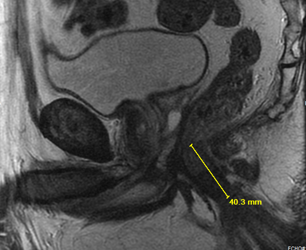 Mri Of Rectal Cancer Tumor Staging Imaging Techniques And Management 