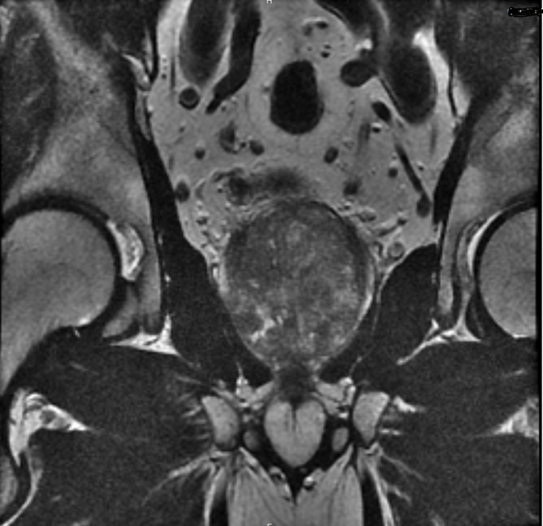 Mr Pelvis With And Without Iv Contrast Greater Waterbury Imaging Center