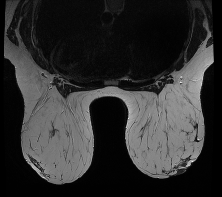 MRI Breast image