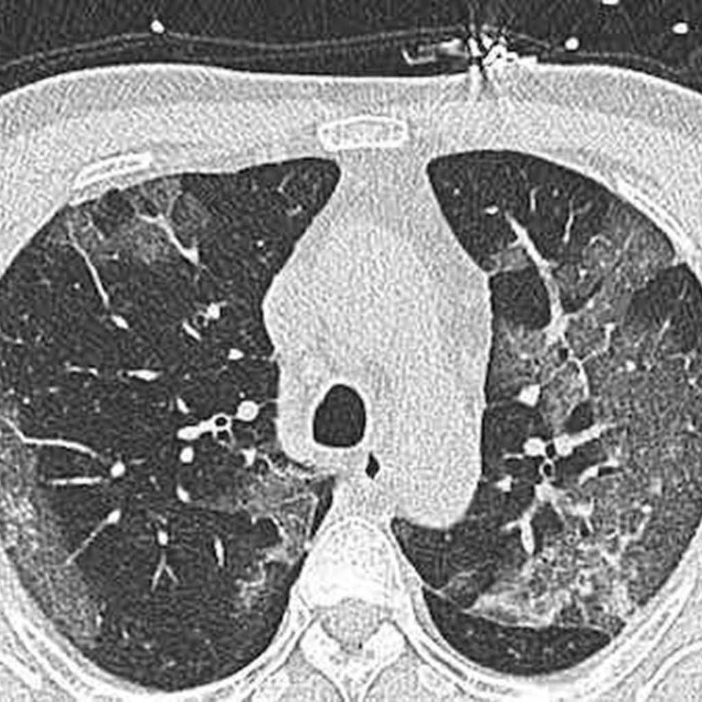 Lung CAT of Covid-19 Patient