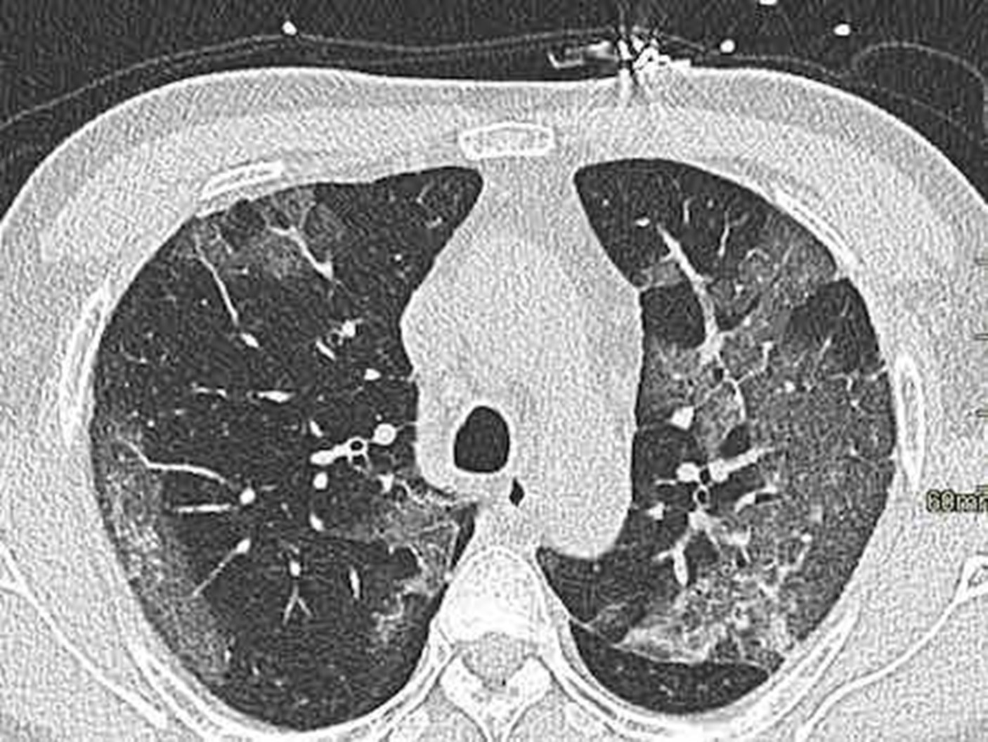 Lung CAT of Covid-19 Patient