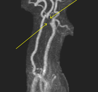 MRA NECK WITH AND WITHOUT IV CONTRAST