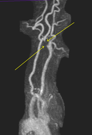 MRA NECK WITH AND WITHOUT IV CONTRAST