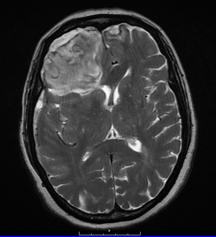 MR HEAD WITH AND WITHOUT IV CONTRAST
