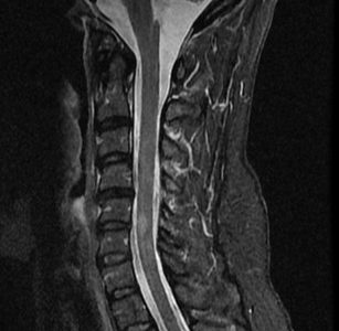 MR CERVICAL SPINE WITH AND WITHOUT IV CONTRAST