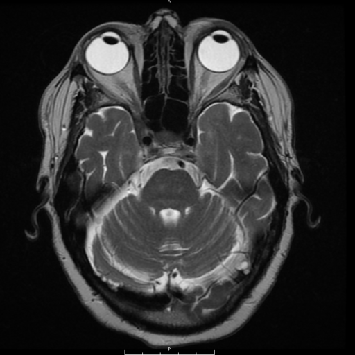 MRI Face Neck Orbit With and Without Contrast