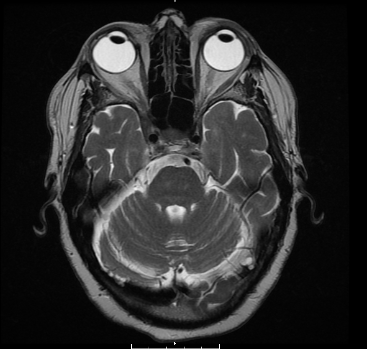 MRI Face Neck Orbit With and Without Contrast