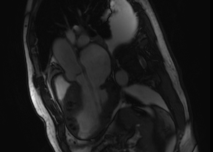 MRI Cardiac Morph & Function w wo Contrast