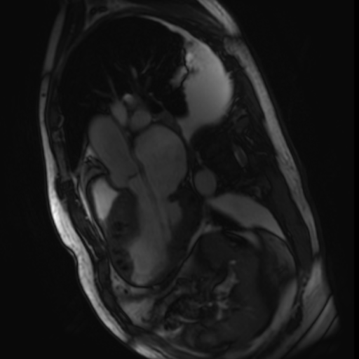 MRI Cardiac Morph & Function w wo Contrast