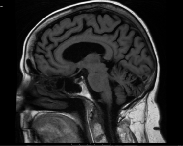 MRI Brain Without Contrast - Greater Waterbury Imaging Center