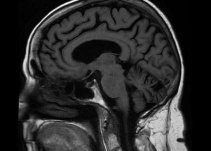 MRI Brain without Contrast