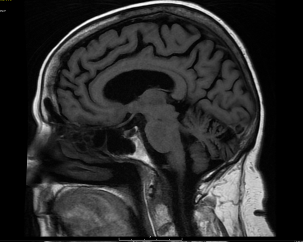 MRI Brain without Contrast