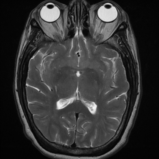 MRI face Neck Orbit