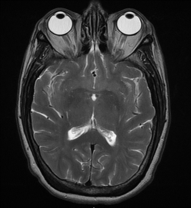MRI face Neck Orbit