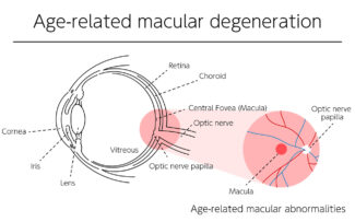 Age related macular degenration - Ophthalmic MRI