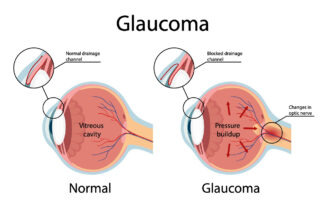 Glaucoma MRI of Eyes Ophthalmic MRI