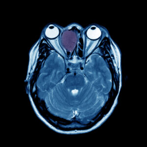 MRI of Brain and Orbits