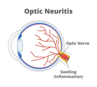 Optic Neuritis Ophthalmic MRI