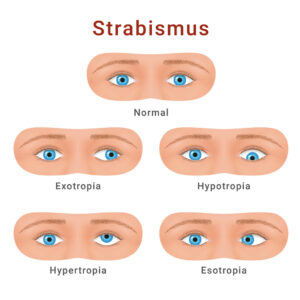 Strabismus - Ophthalmic MRI