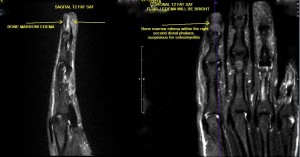 MRI of upper extremity